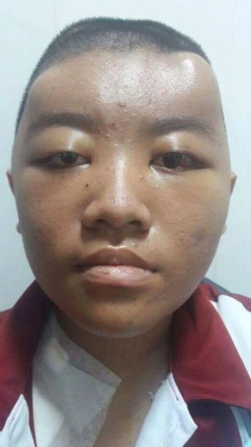 Giúp em Thi điều trị ung thư máu